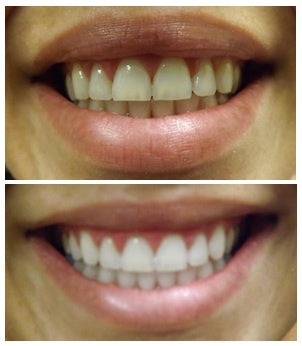 Dentist-Approved Whitening Toothpaste