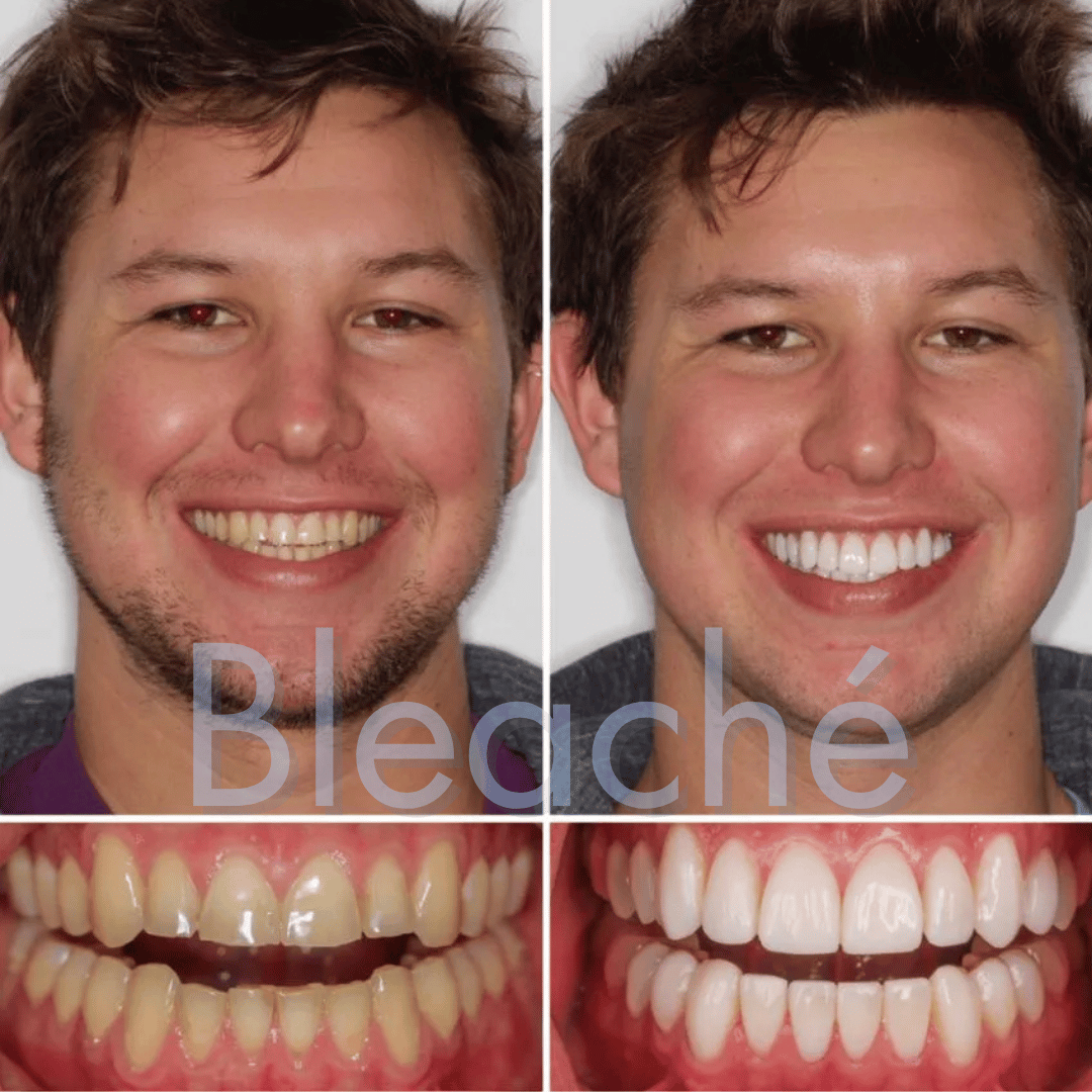 Bleaché Powder