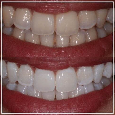 Dentist-Approved Whitening Toothpaste