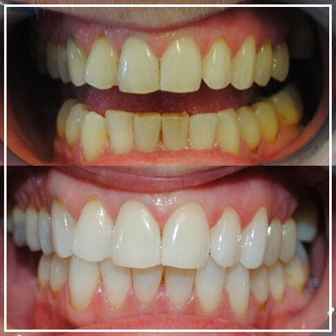 Dentist-Approved Whitening Toothpaste