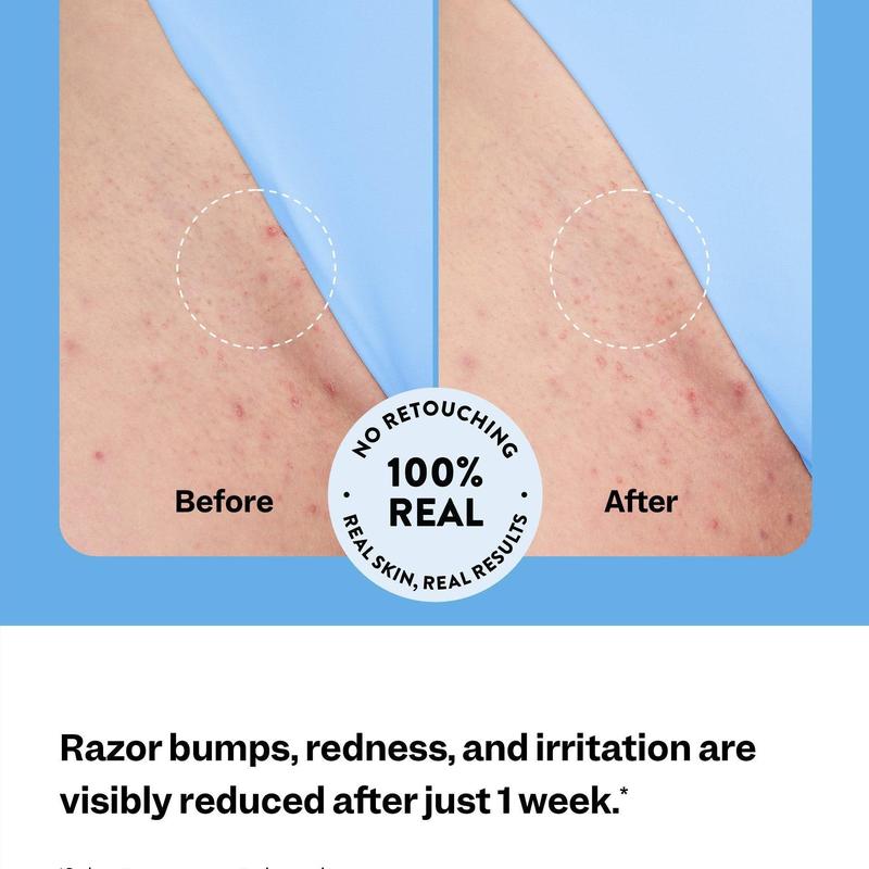 Anti Breakout: Skin Smoothing Roller
