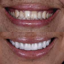 Dentist-Approved Whitening Toothpaste