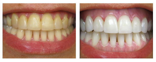 Dentist-Approved Whitening Toothpaste