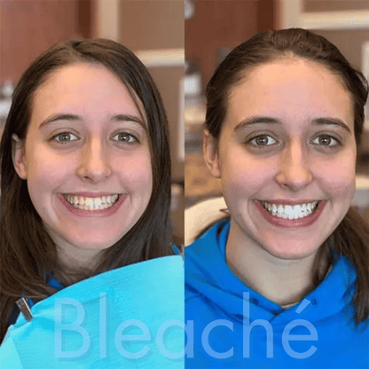Bleaché