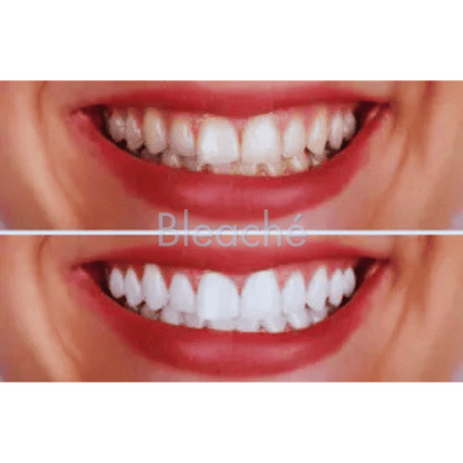Bleaché