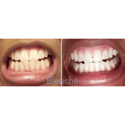Bleaché