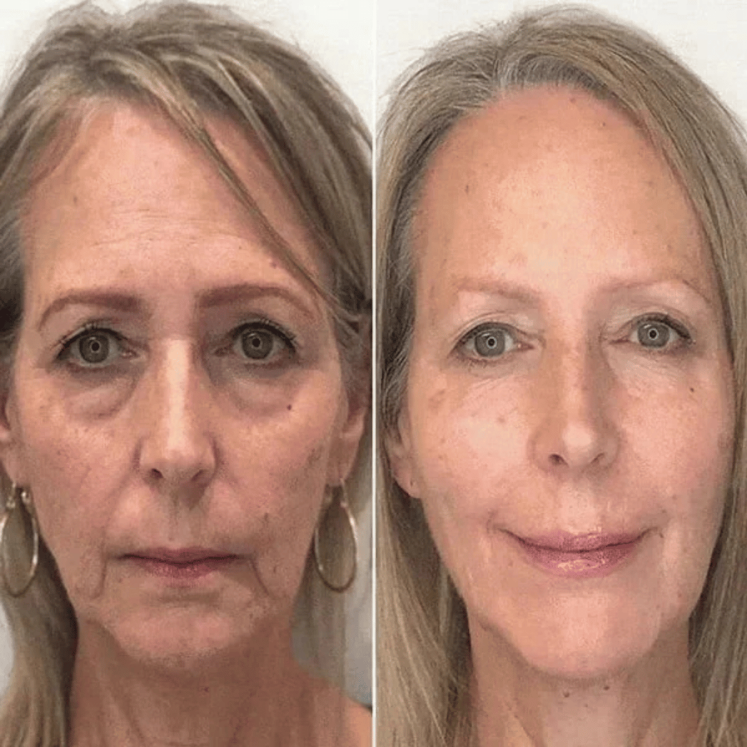 Samui | FACELIFT Botoxserum C