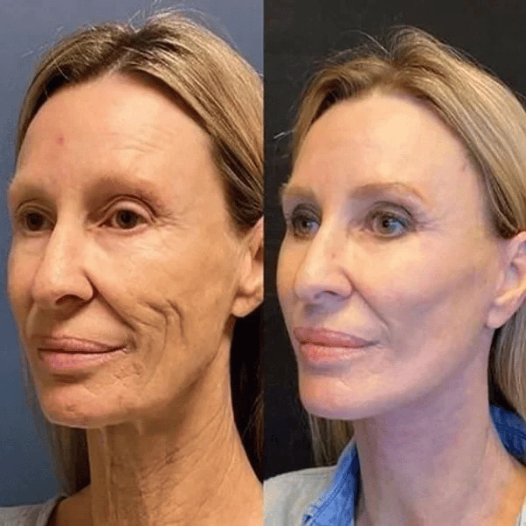 Samui | FACELIFT Botoxserum C