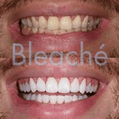 Bleaché