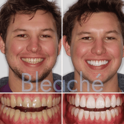 Bleaché