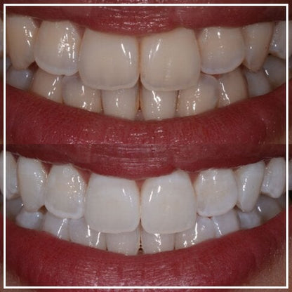 Dentist-Approved Whitening Toothpaste