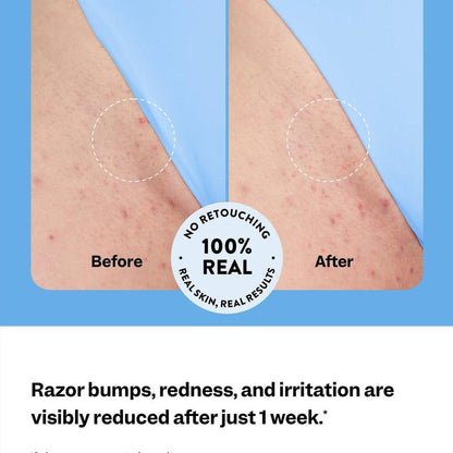 Anti Breakout: Skin Smoothing Roller